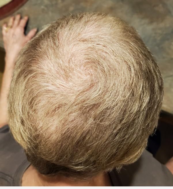 illumiflow 272 Laser Cap for Hair Growth - FDA Cleared Low Level Laser Therapy Hair Regrowth System for Men & Women - Hair & Scalp LLLT Hat w/Lasers Stops Hair Loss & Regrows Thinning Hair customer photo 2