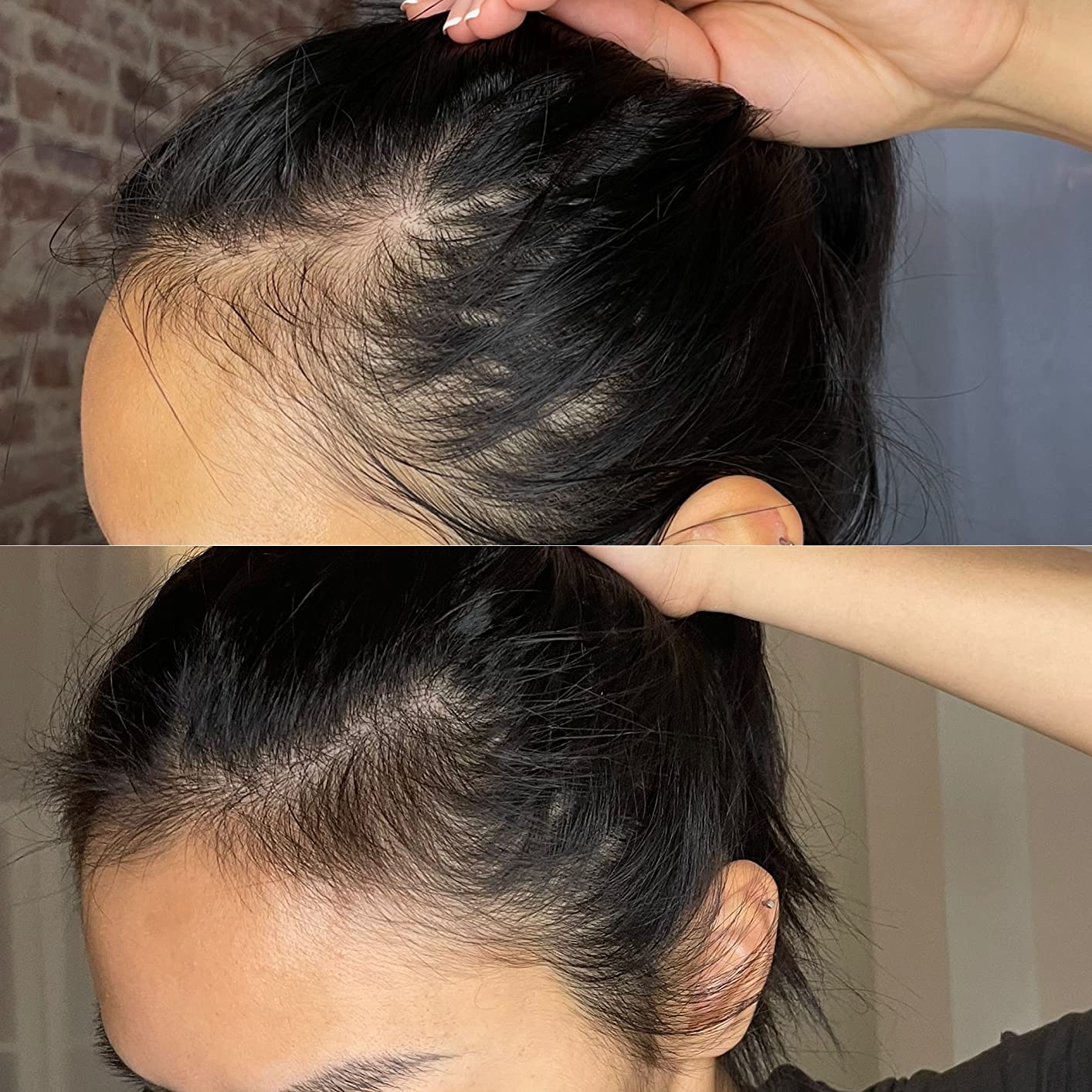 Hairmax Ultima 9 Classic LaserComb, FDA Cleared Red Light For Hair Regrowth customer photo 2