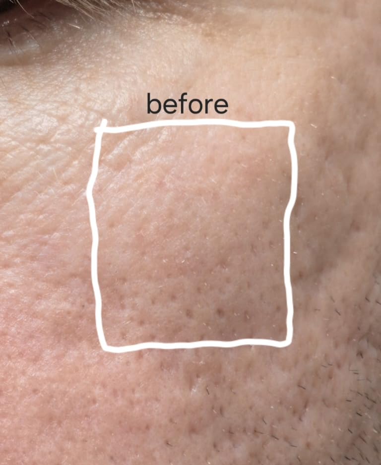 NIRA - FDA Cleared Anti Aging Laser, Red Light Mask Alternative, Large Area customer photo 2